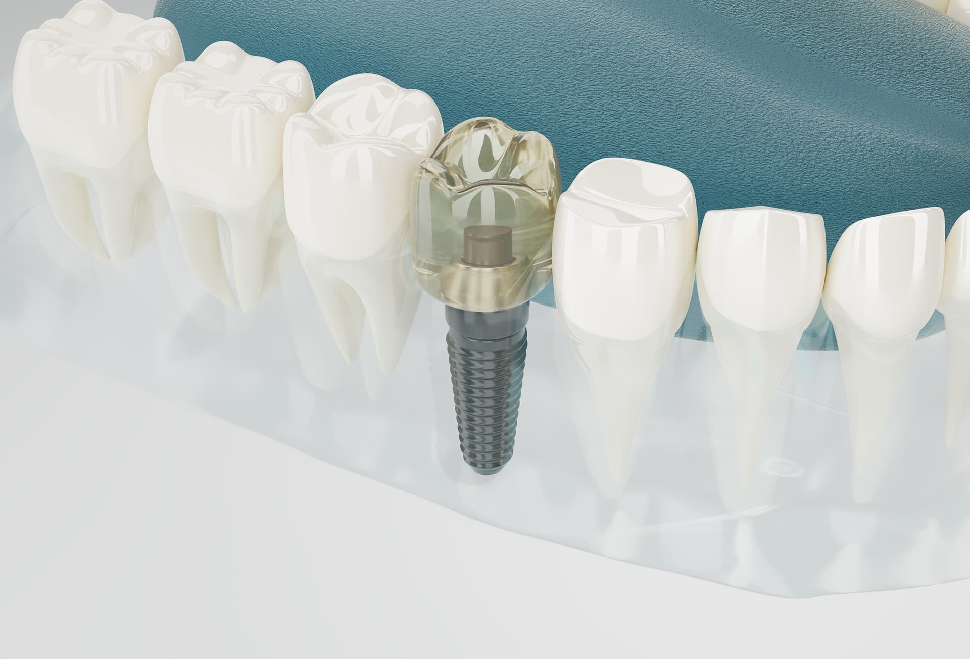Tooth Implant